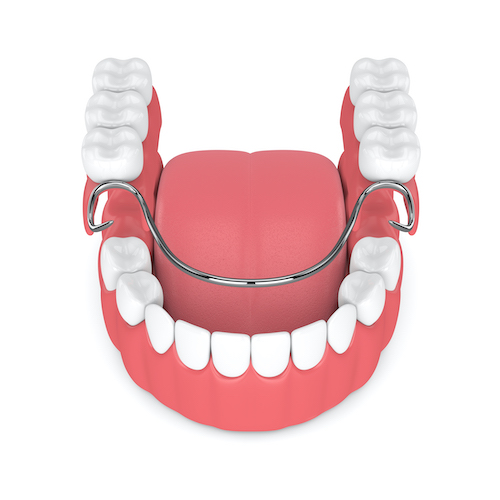 3d render of removable partial denture